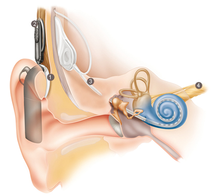 How Cochlear Implant Works - East Alabama ENT