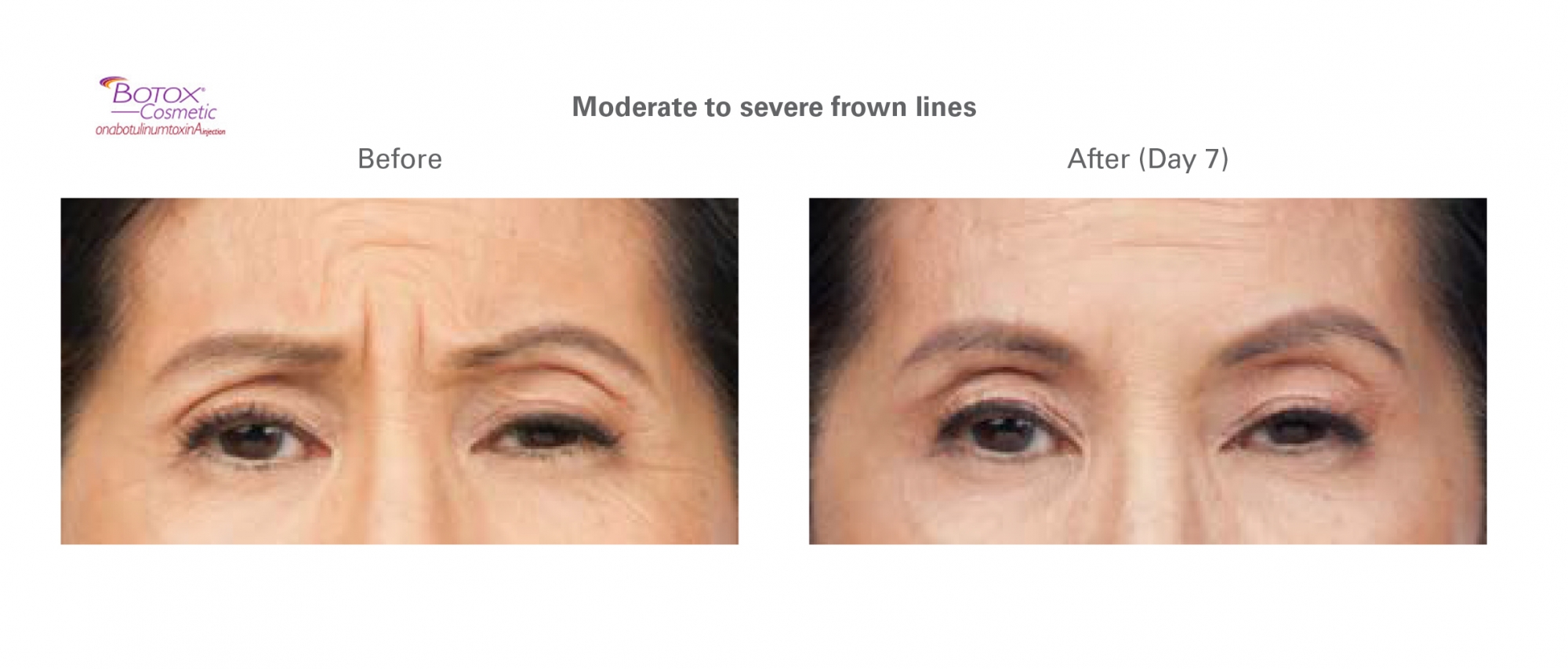 before and after results for Botox treatment of the brow
