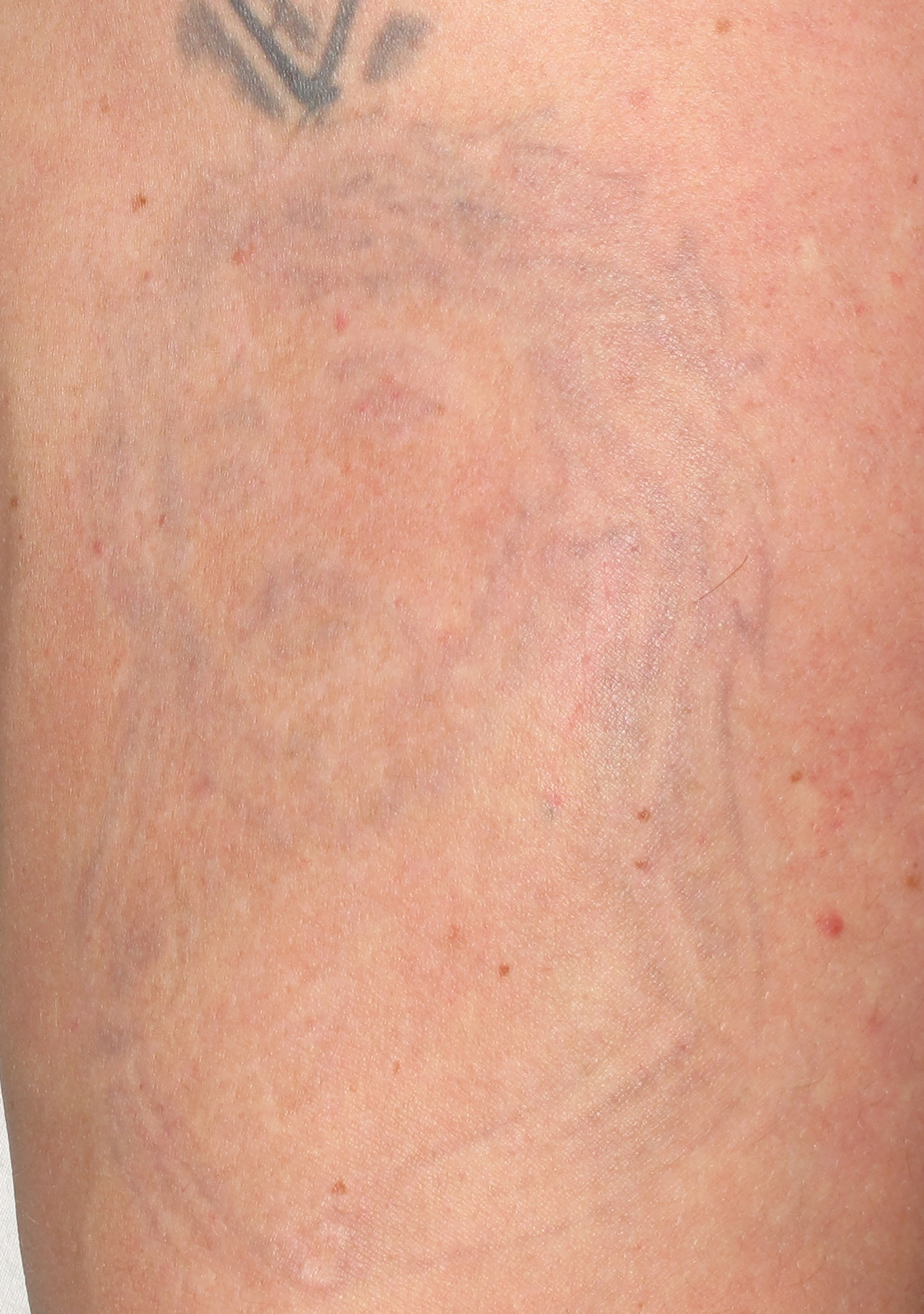 tattoo after treatment with the Spectra laser in Altoona and State College, Pennsylvania