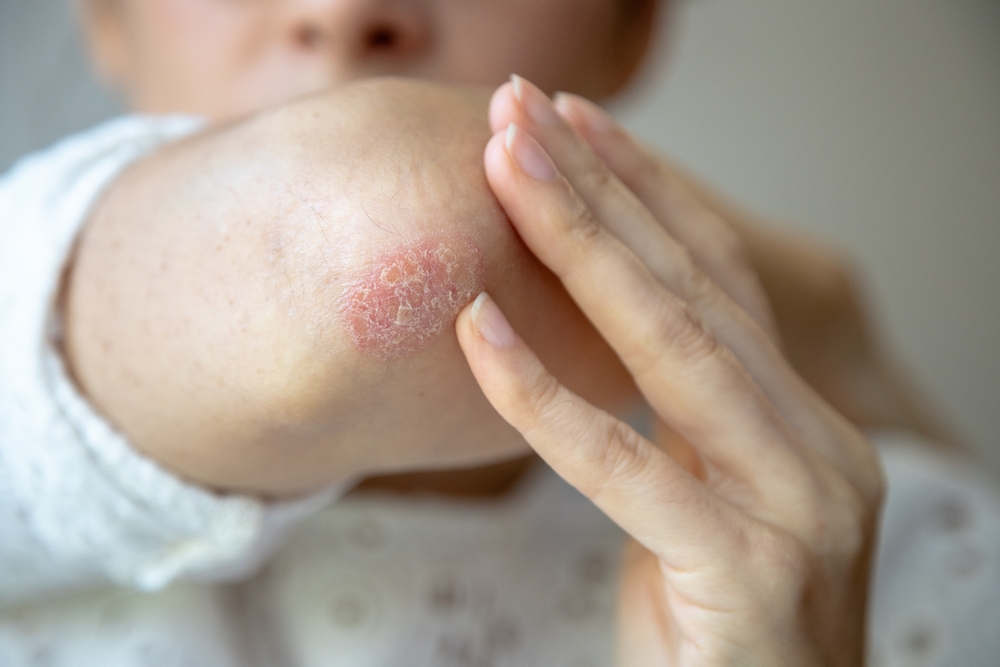 Psoriasis in Mesa, Sun City, Casa Grande, Gold Canyon, & Chandler, AZ