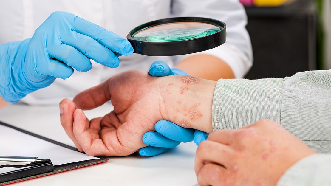 Eczema in Mesa, Sun City, Casa Grande, Gold Canyon, & Chandler, AZ