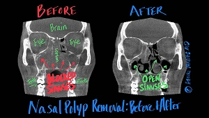 Nasal Polyp Removal CT Scans