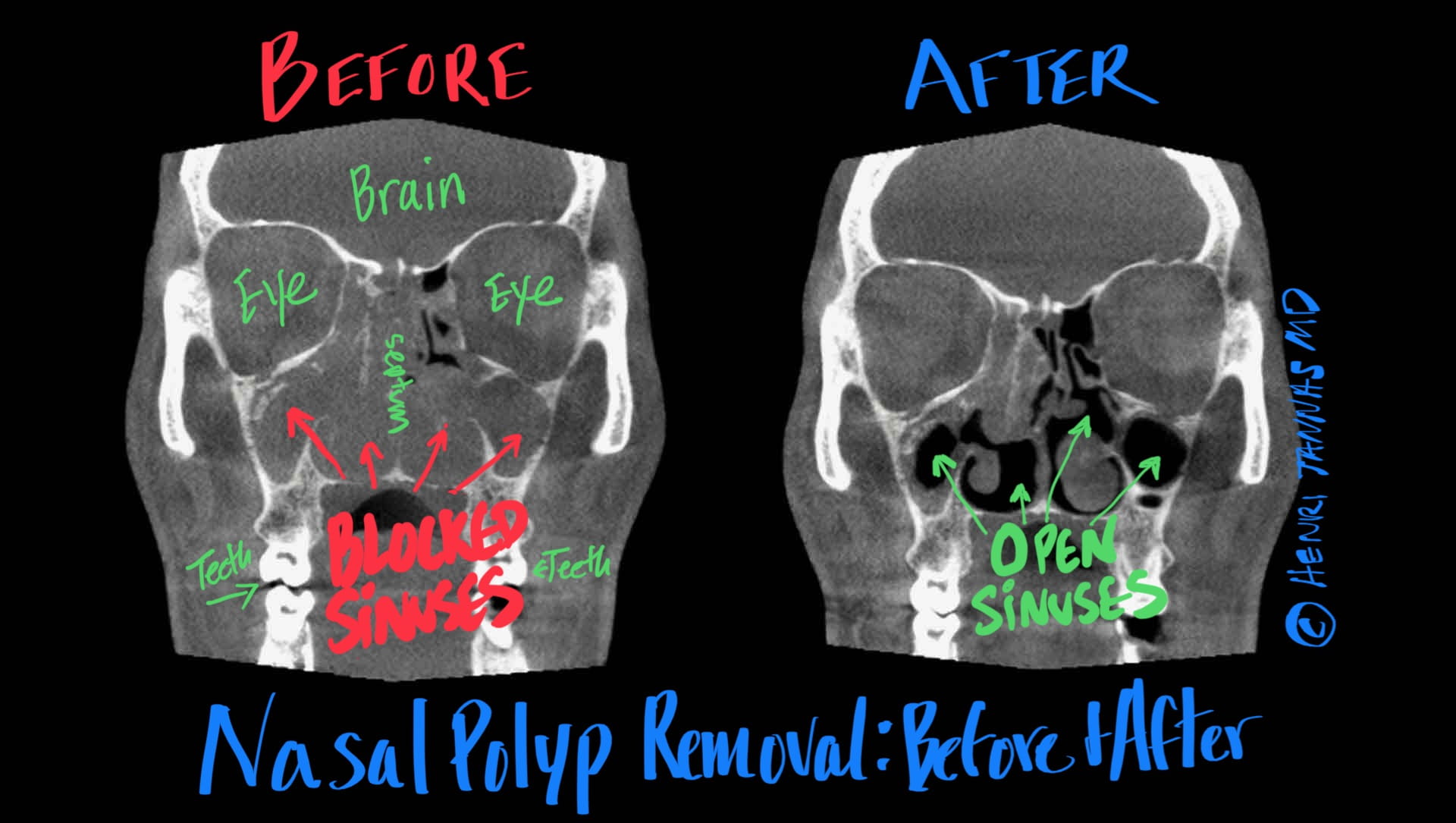 Before & After Sinus CT - Nasal Polyp Removal Walnut Hill ENT Tannas