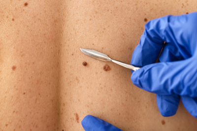 Small-knife-ready-to-remove-the-mole-in-back-of-patient.