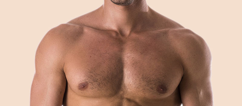 Gynecomastia