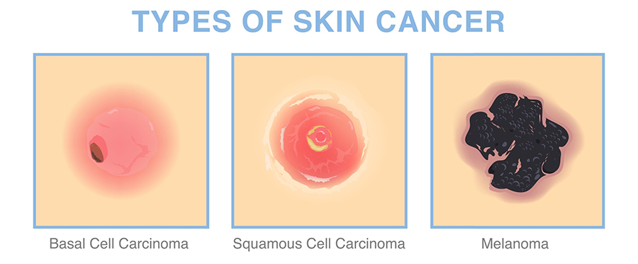 Squamous cell carcinoma (SCC)