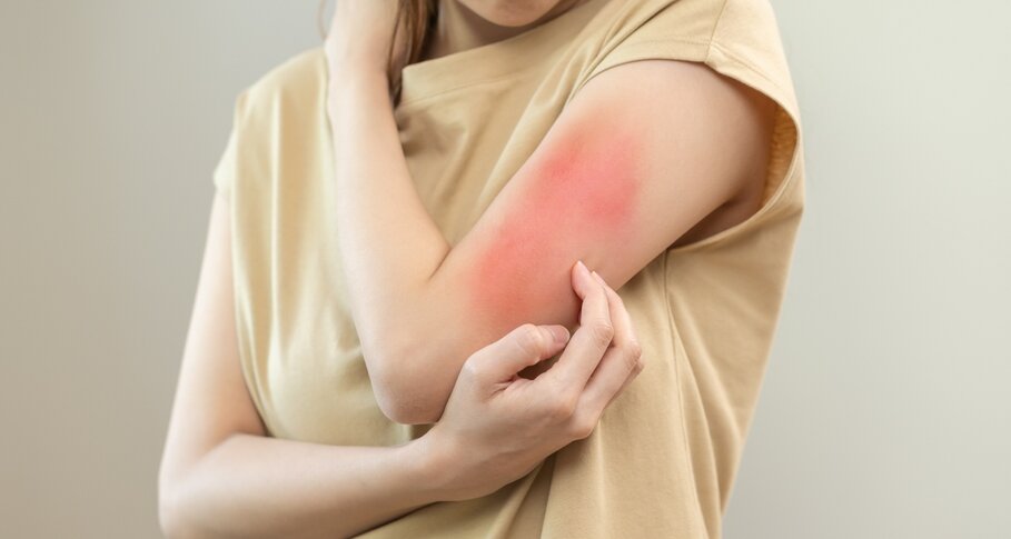 Rashes & Allergic Reactions